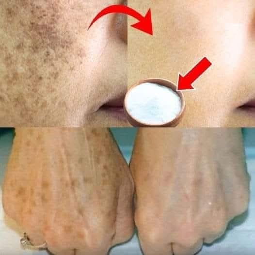I Got Rid of My Age Spots Using an Inexpensive Kitchen Item: Baking Soda