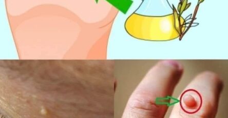 Natural recipe to get rid of warts using tea tree oil