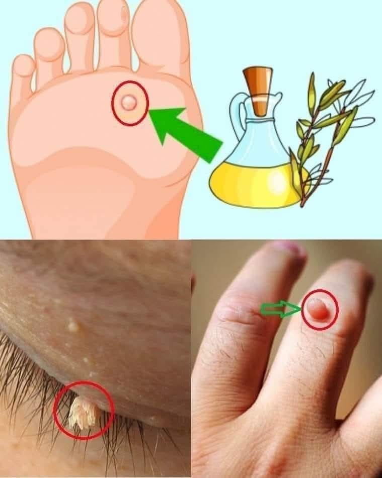 Natural recipe to get rid of warts using tea tree oil
